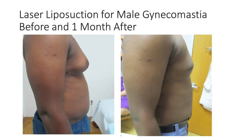 Male Breast Reduction Liposuction Before and After 2