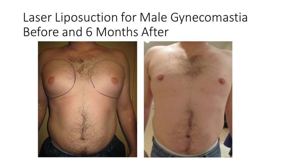 Male Breast Reduction Liposuction Before and After 3