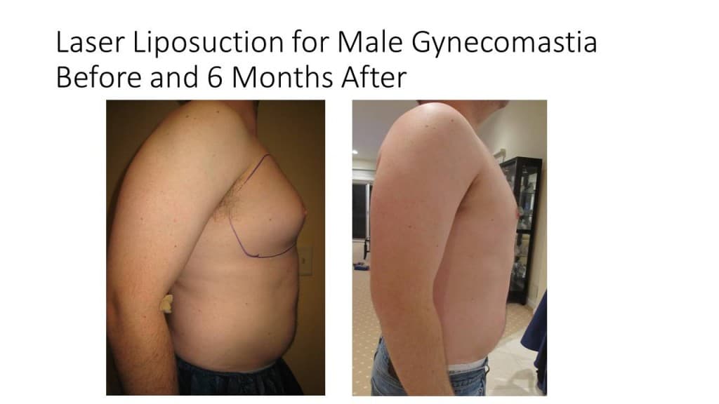 Male Breast Reduction Liposuction Before and After 4