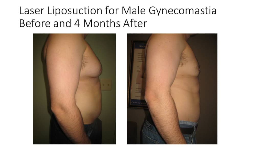 Male Breast Reduction Liposuction Before and After 5