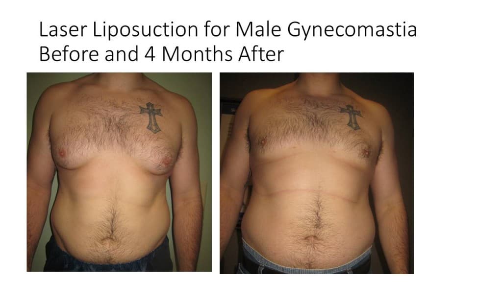 Male Breast Reduction Liposuction Before and After 6