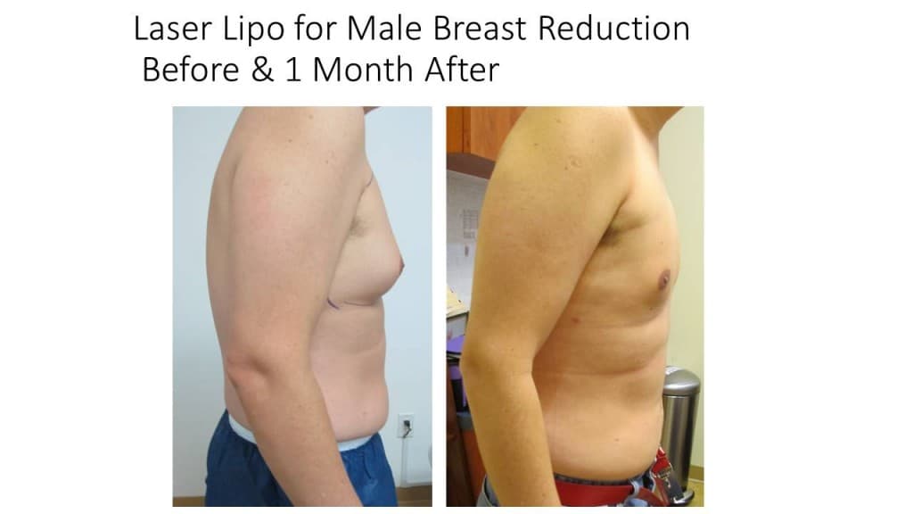 Male Breast Reduction Liposuction Before and After 8