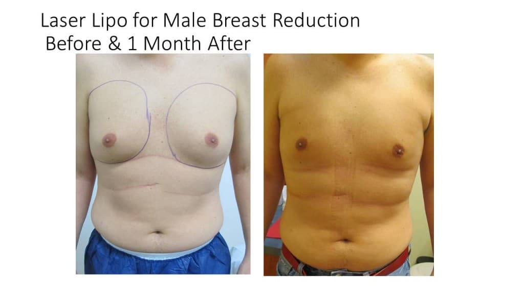Male Breast Reduction Liposuction Before and After 9