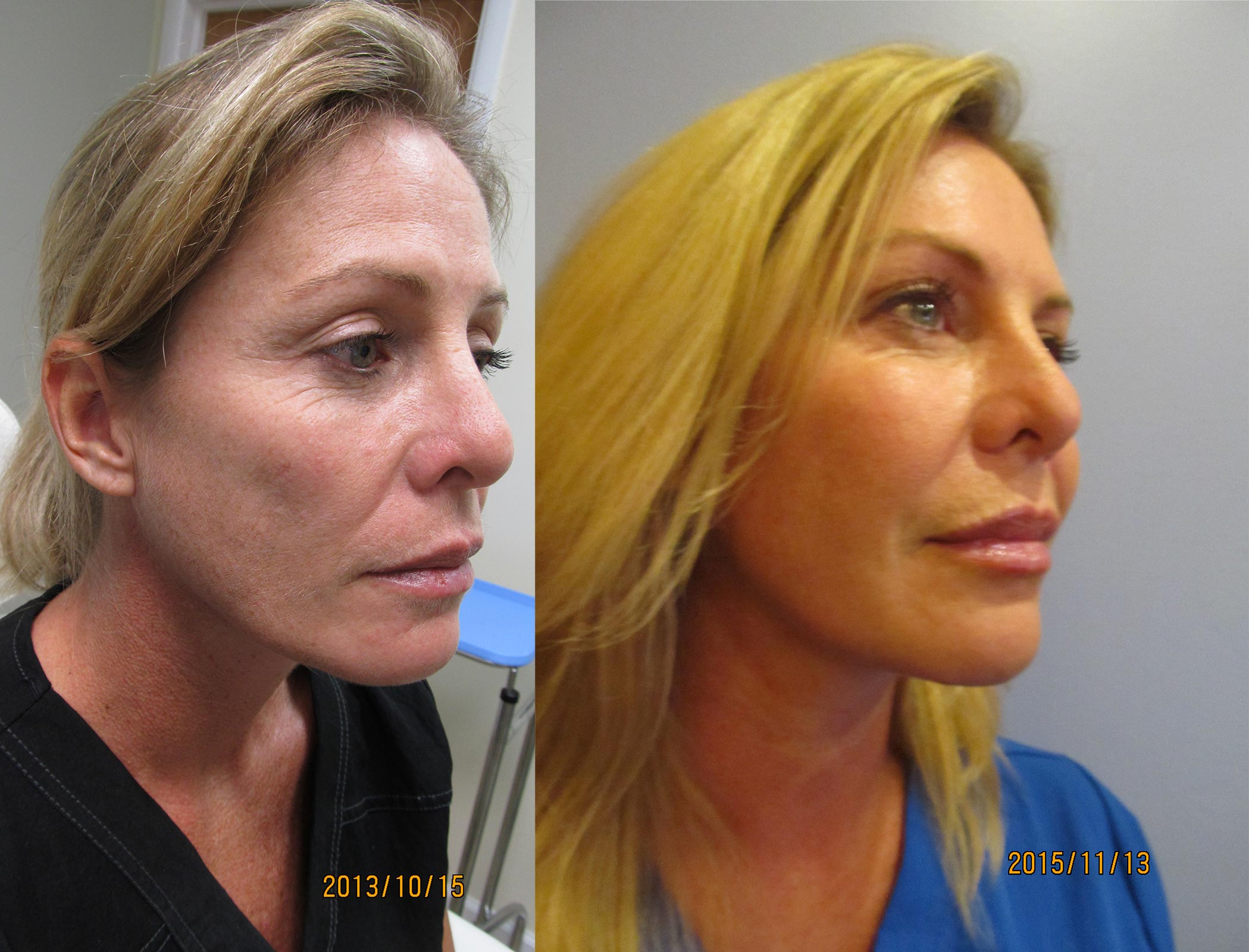 Fat Transfer to Face Before and After Photo 1
