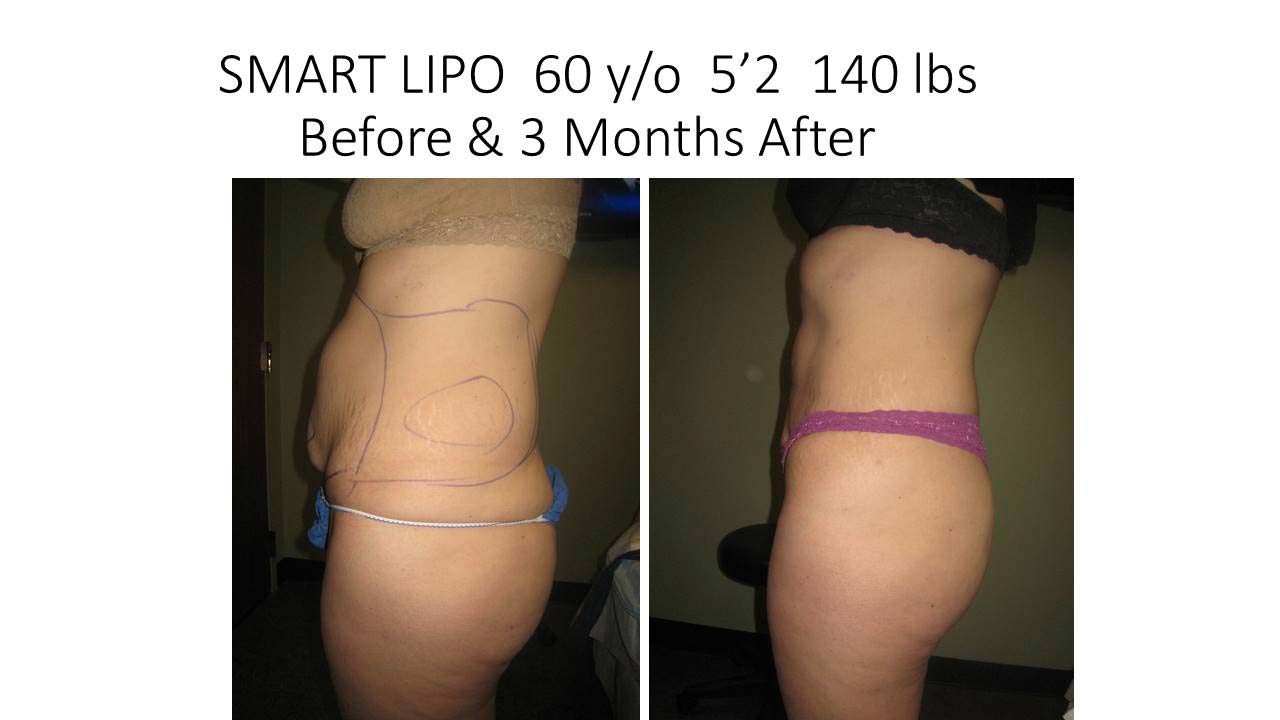 Liposuction Abdomen Fat Removal Before and After Photo 15