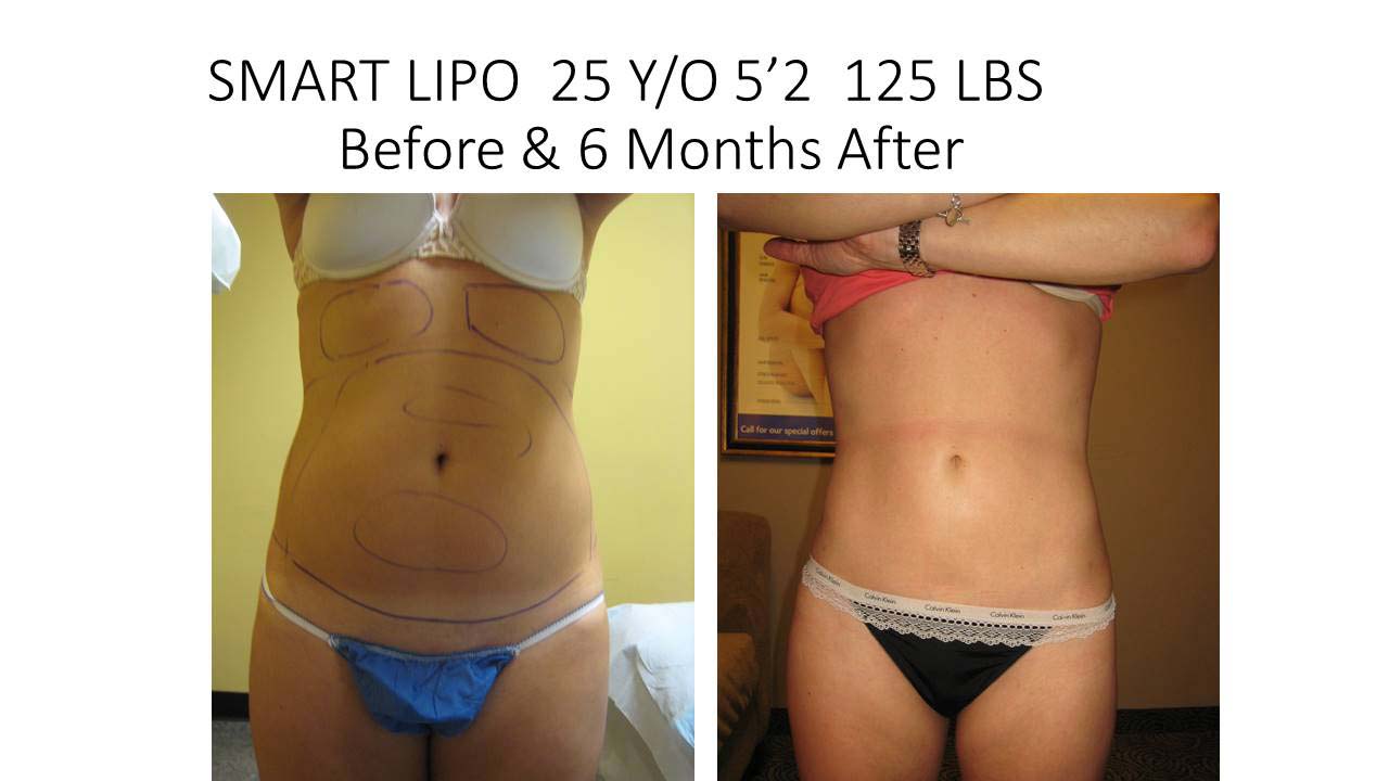 Liposuction Abdomen Fat Removal Before and After Photo 3