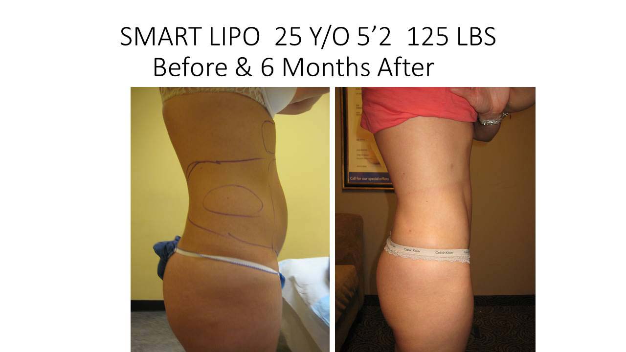 Liposuction Abdomen Fat Removal Before and After Photo 4