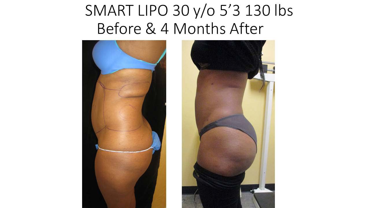 Liposuction Fat Removal Before and After Photo 12