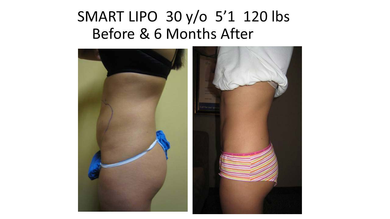 Liposuction Fat Removal Before and After Photo 17