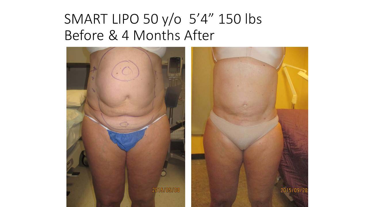 Smart Liposuction Before and After Photos