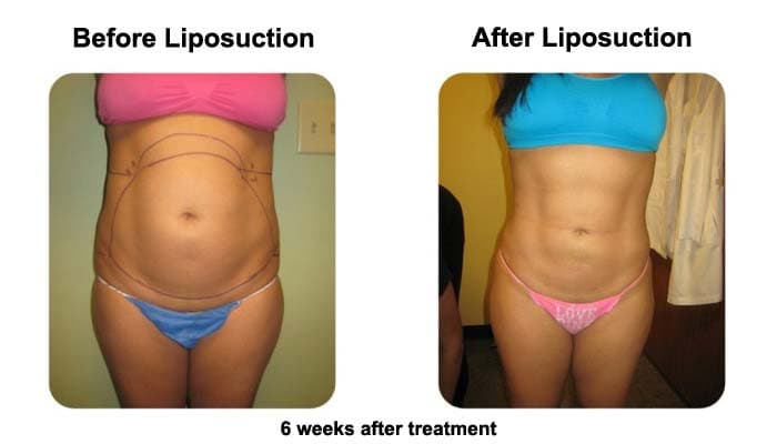 Smart Liposuction Abdomen Before and After Photo 1
