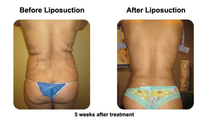 Smart Liposuction Back Before and After Photo 3